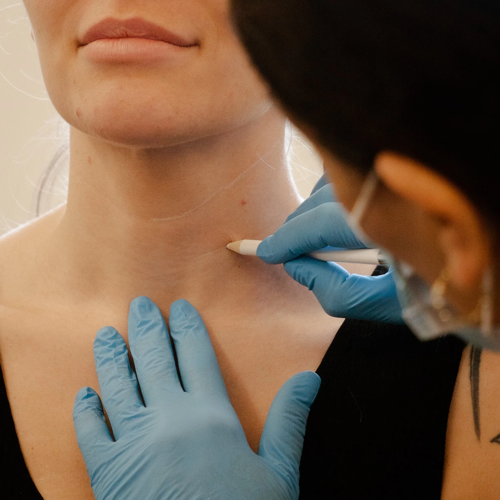 Tracing on a client before filler and botox