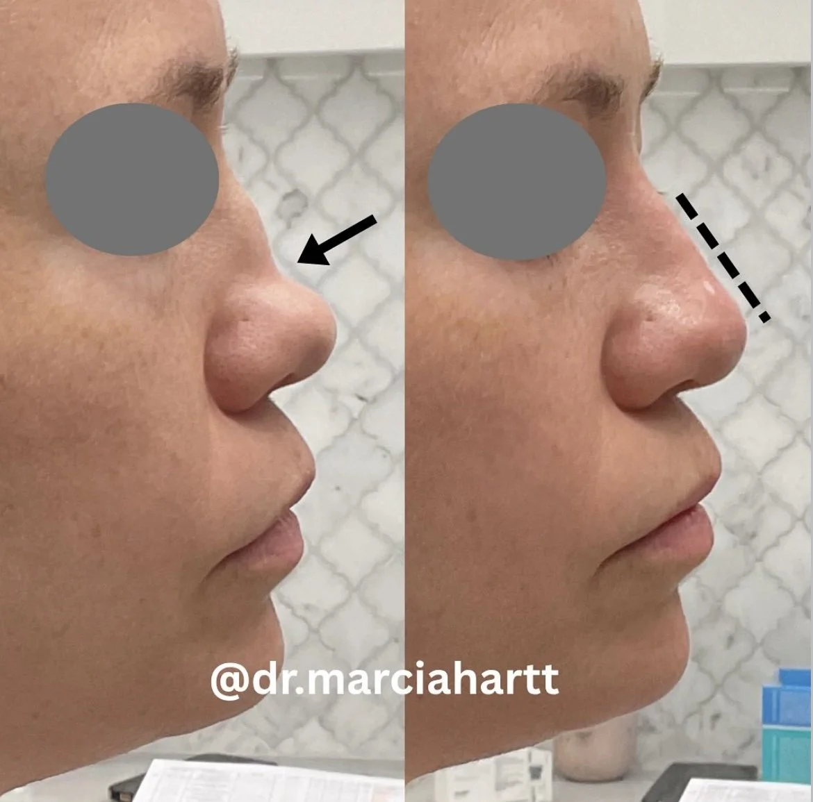 Before and after non-surgical rhinoplasty using dermal filler by Dr. Marcia Hartt in St. Albert, showing improved nasal profile and contour.