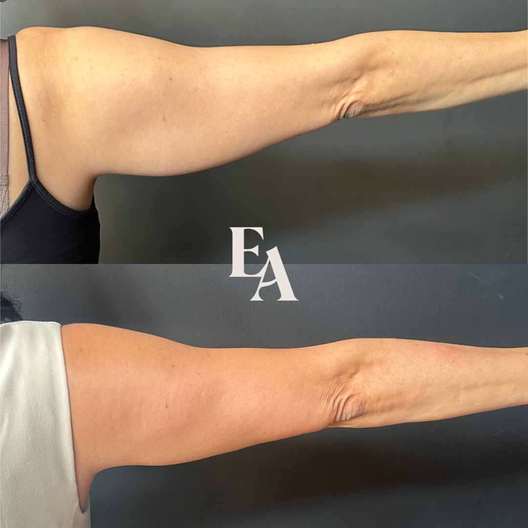 CoolSculpting Arms Before and After Kelowna.PNG