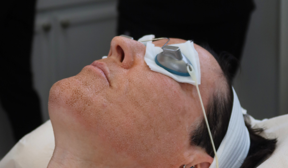Patient undergoing CO₂ laser resurfacing with protective eye shields during a Lutronic eCO₂ laser skin resurfacing treatment.