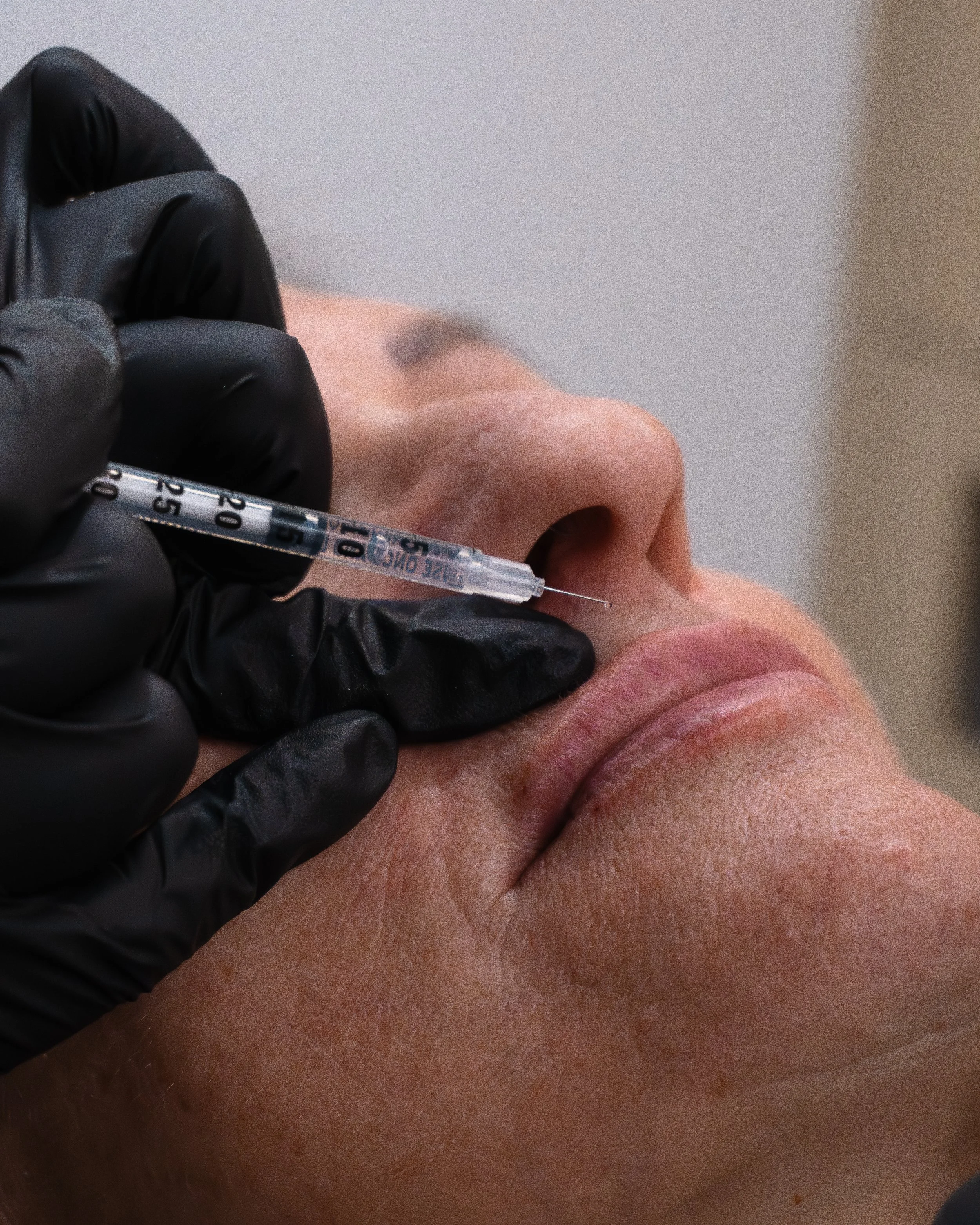 Tracing on a client before filler and botox