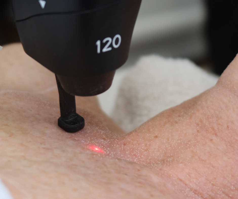 Close-up view of fractional CO₂ laser resurfacing using the Lutronic eCO₂ laser to stimulate collagen and improve skin texture.