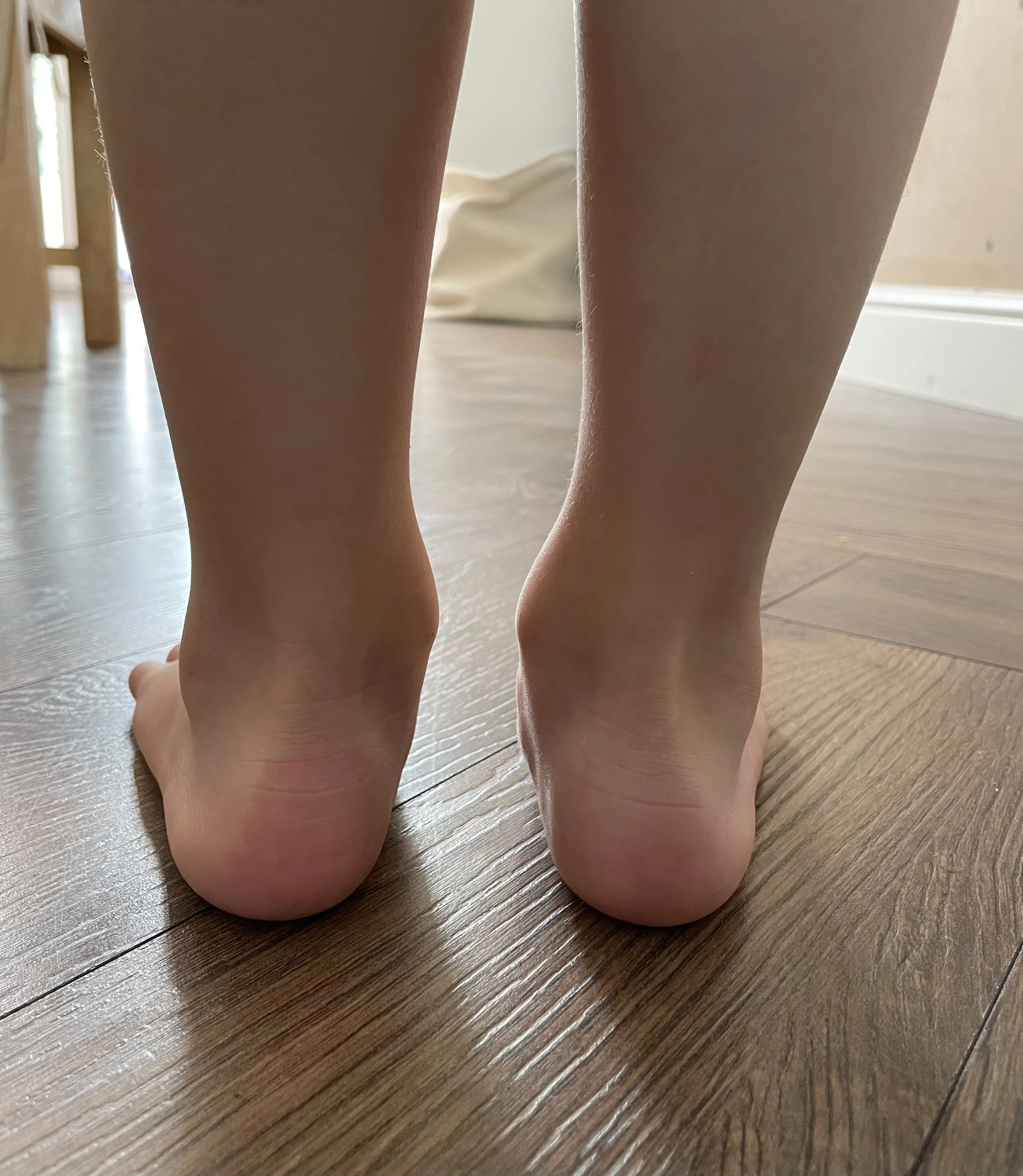 Flat Feet In Children