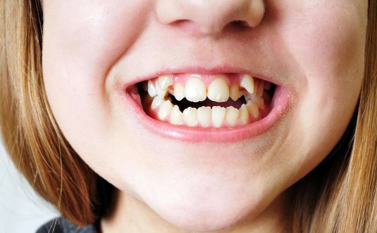 Can Crooked Teeth Affect Your Health?