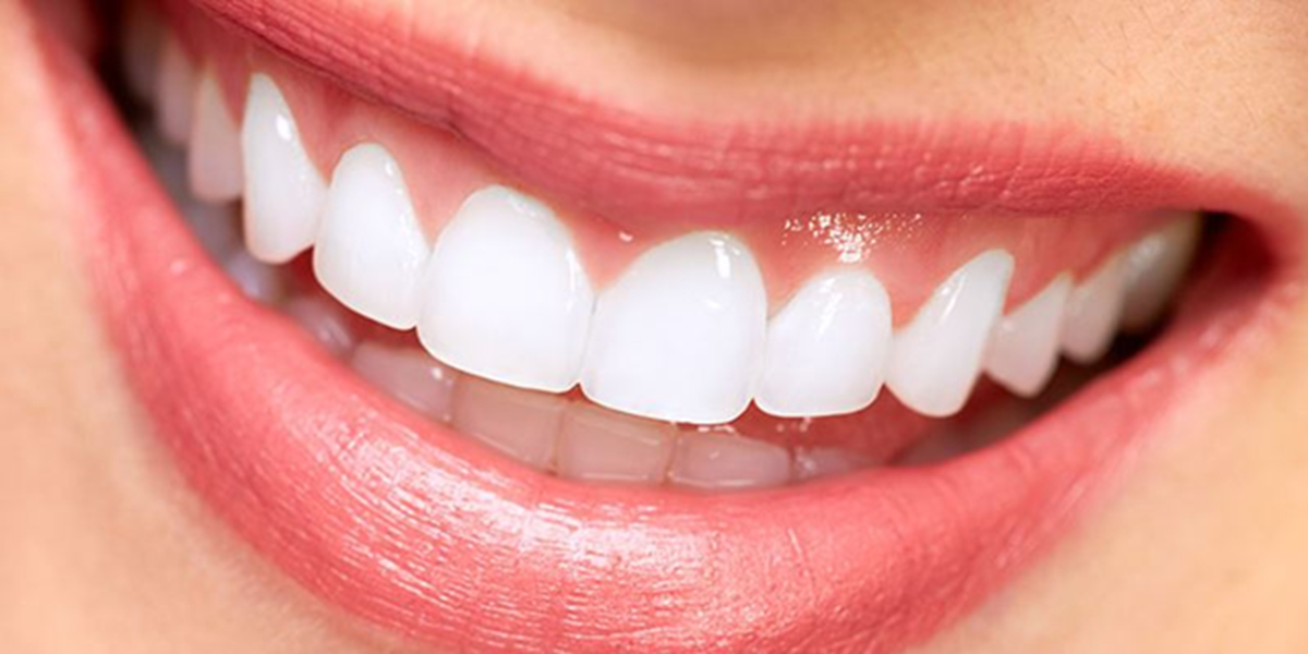 How Long Do Veneers Really Last? Maintenance Tips from a Cosmetic Dentist