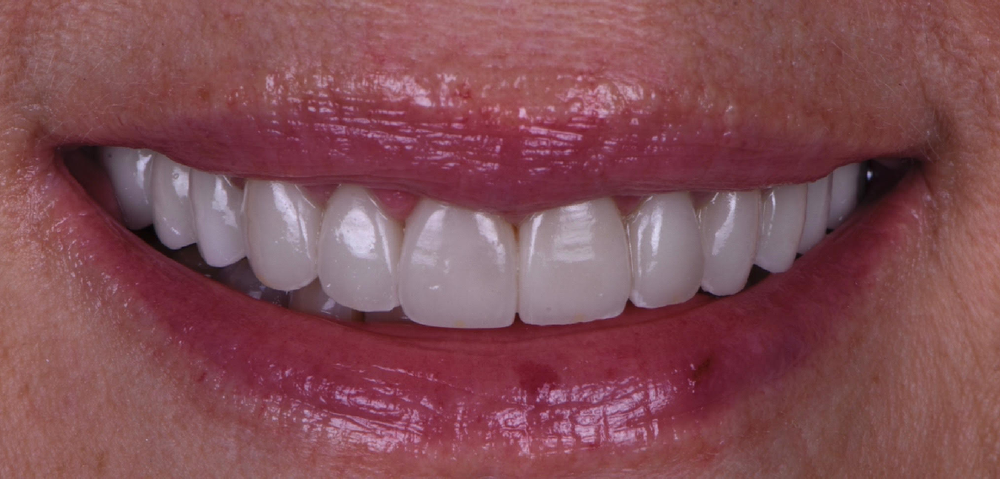 Snap-On Smile by DenMat