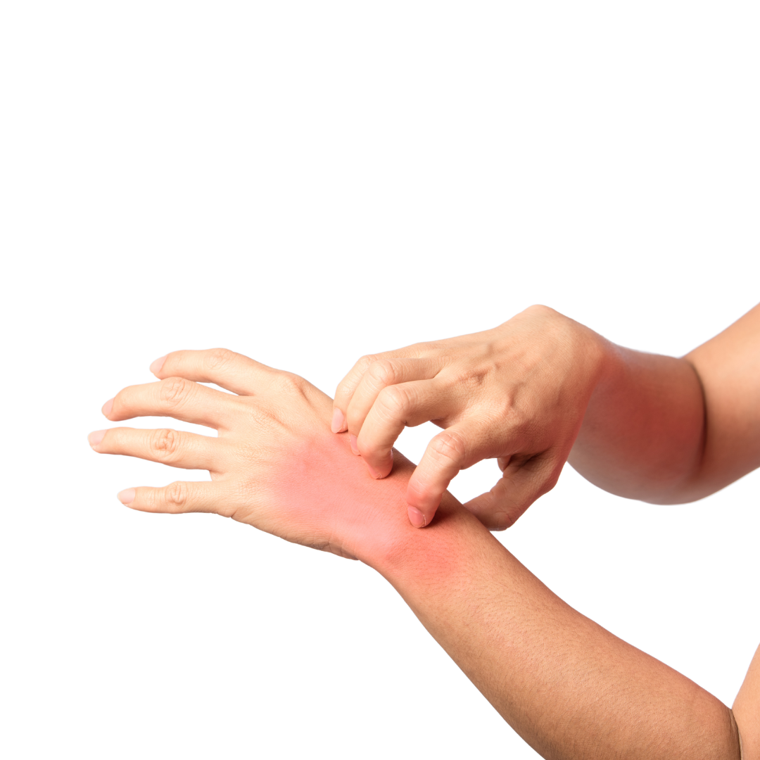 Skin-prick allergy testing on an arm
