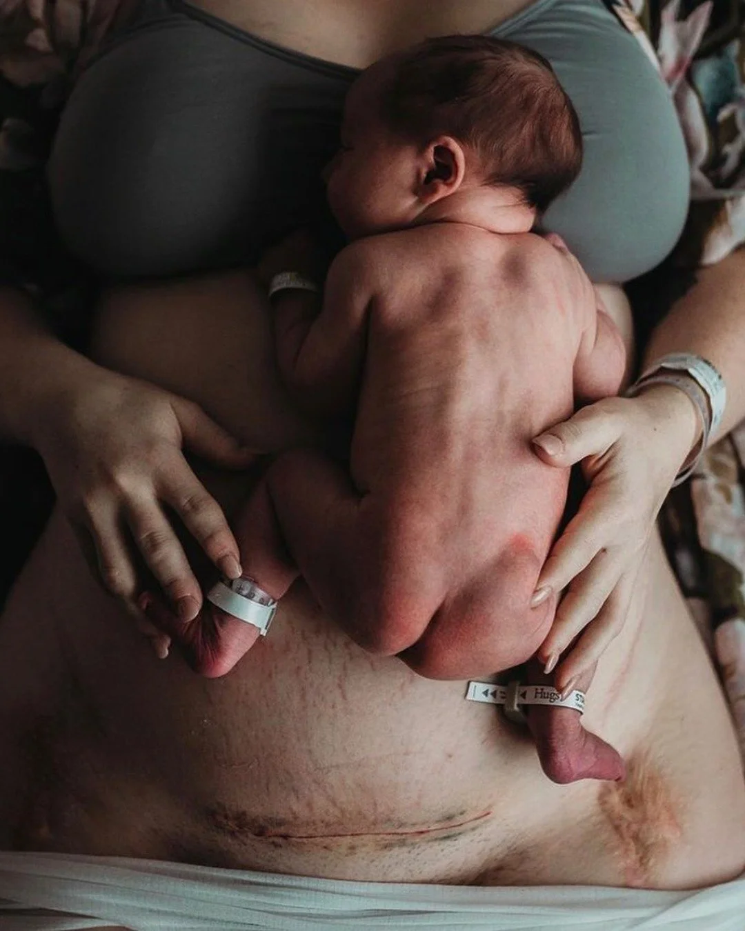 ✨ Recovering from a Caesarean? Here&rsquo;s what you need to know ✨

Whether it was planned or unexpected, your body needs gentleness and patience in the weeks after a C-section. Healing usually takes 6&ndash;8 weeks, so give yourself permission to t