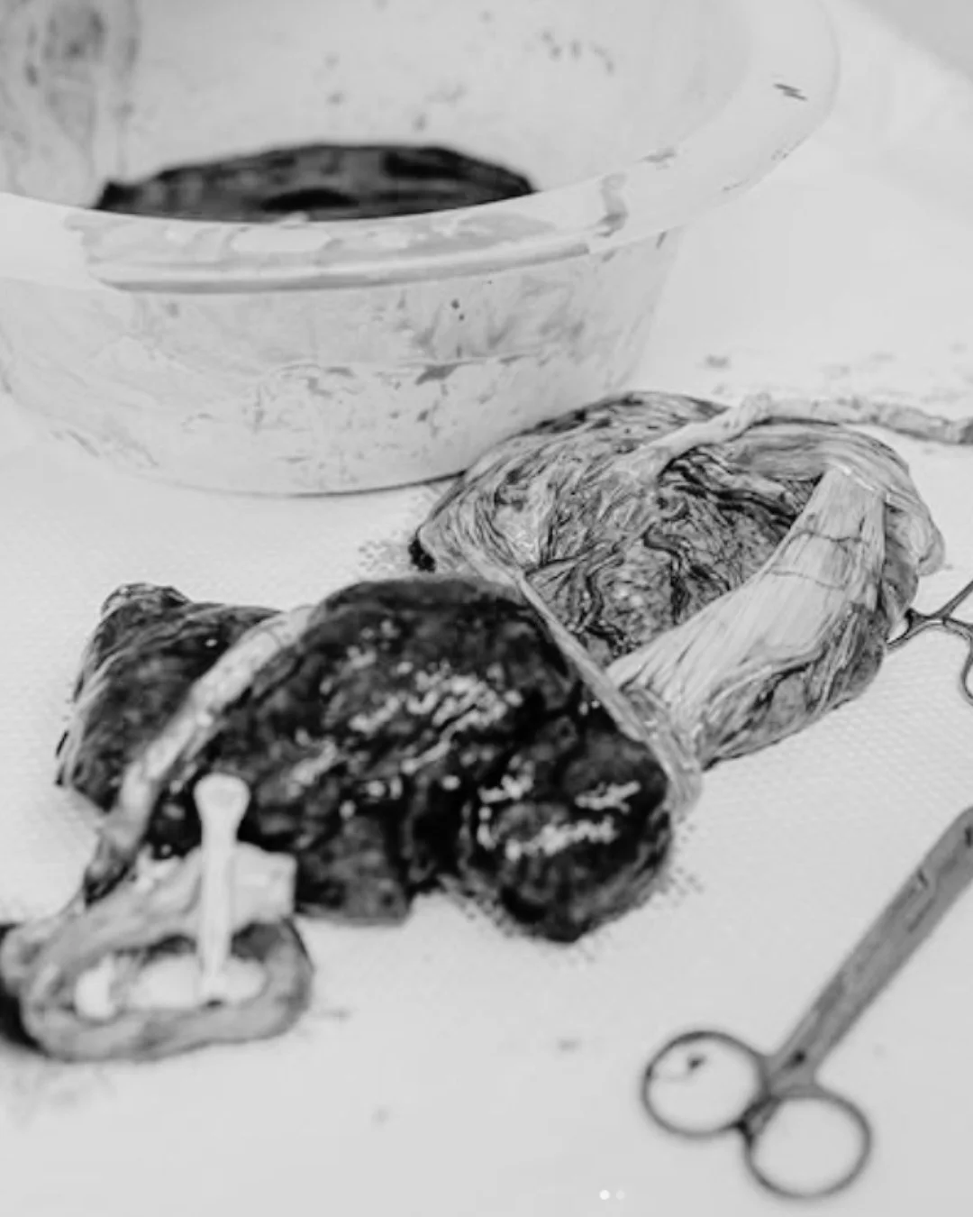 ✨ Twin Placentas ✨

Did you know that most twins have their own placenta? Each baby gets their very own lifeline, bringing nutrients and oxygen straight from you. 🤍

In some twin pregnancies, babies share a placenta, which is called monochorionic. T