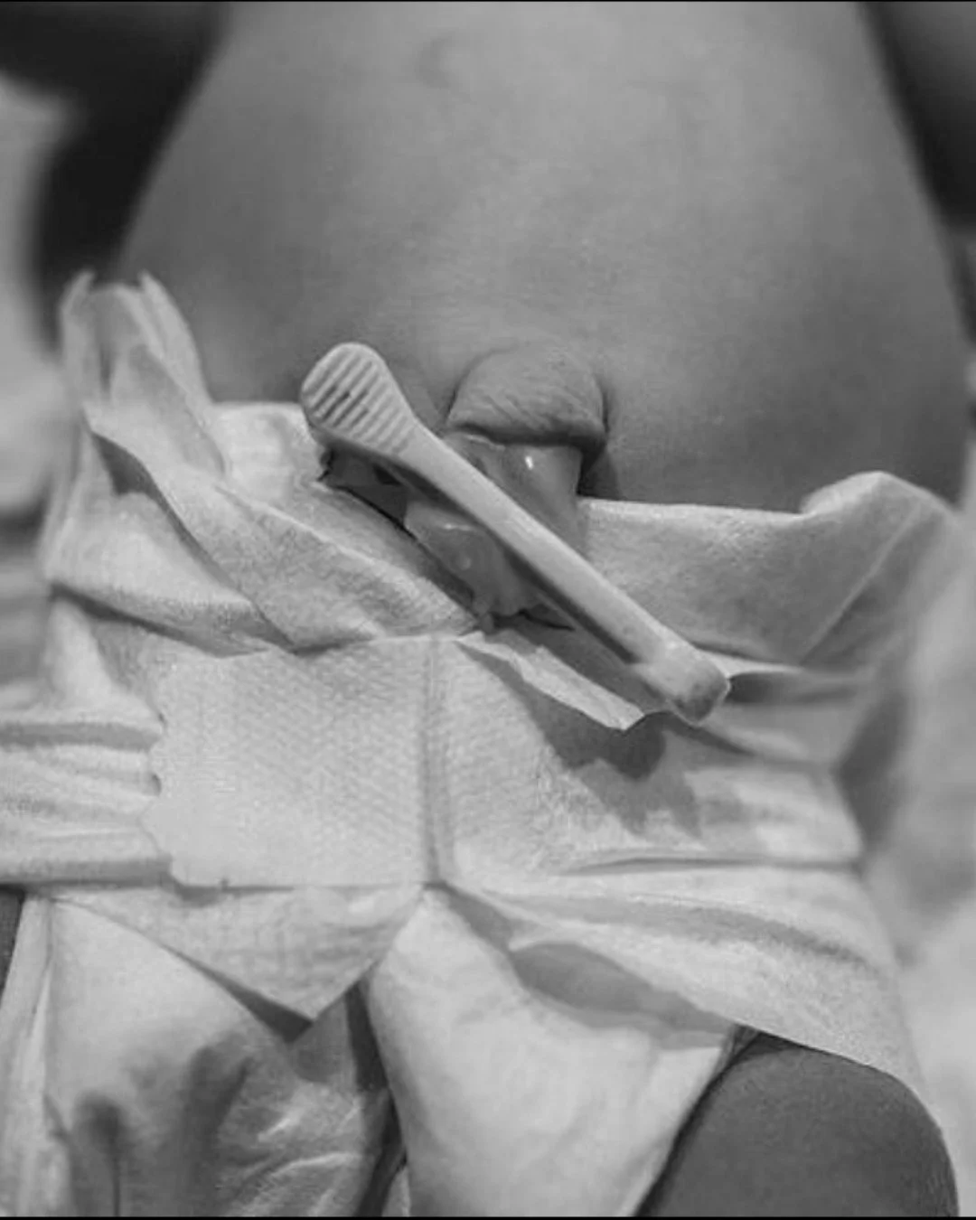 Caring for Your Baby&rsquo;s Umbilical Cord

Your baby&rsquo;s little cord is delicate, but caring for it is easier than you might think. Here&rsquo;s a simple guide to keeping it clean, safe, and comfortable:

💫 Keep it tucked away

Fold the nappy 