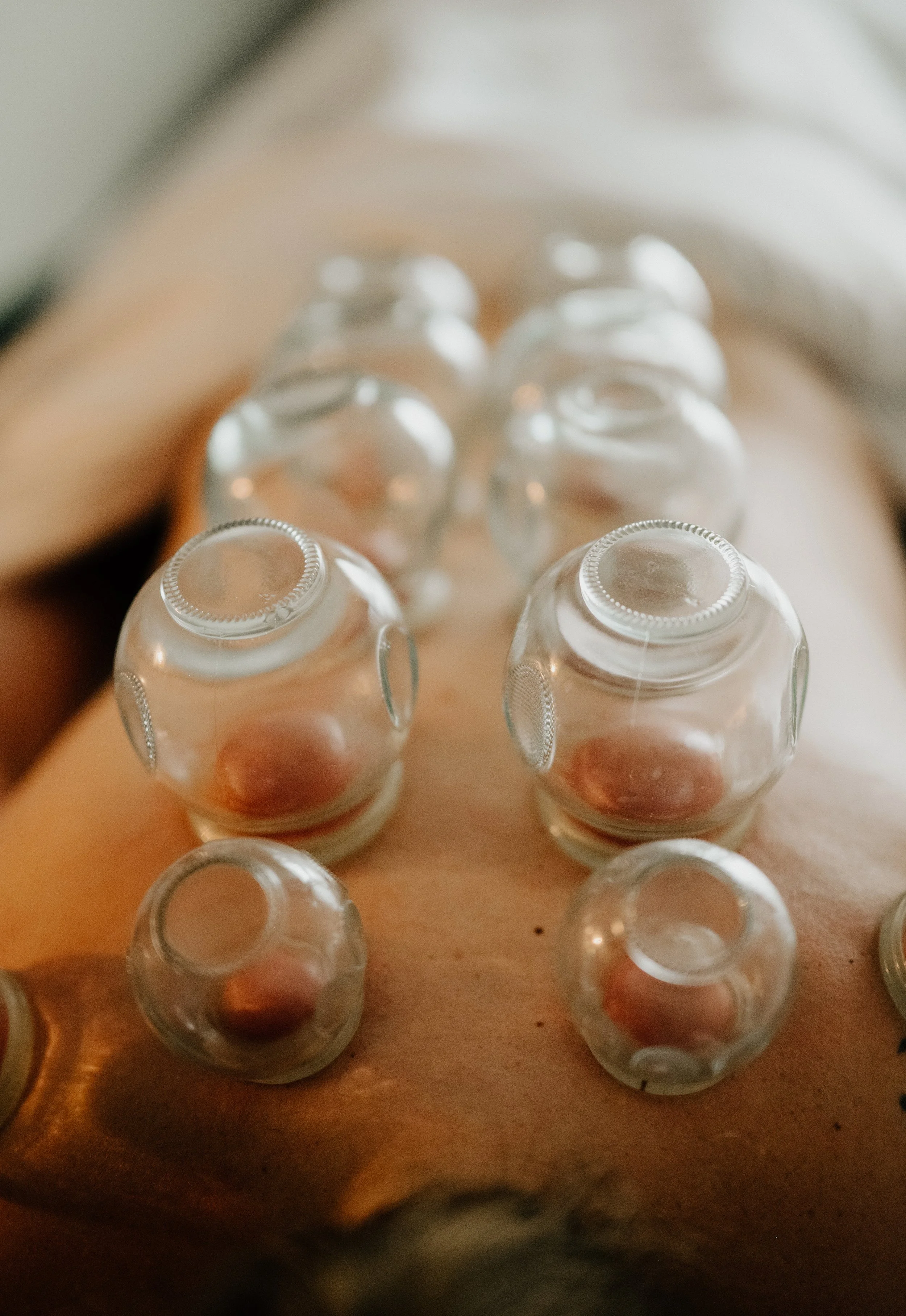 Close-up of glass cupping therapy on a person's back, with multiple glass cups creating suction.