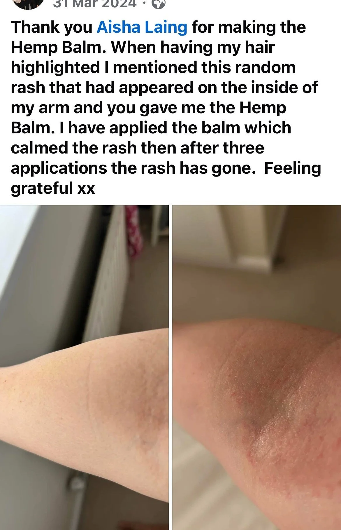Comparison photo of a person's arm showing a rash before and after applying hemp balm.