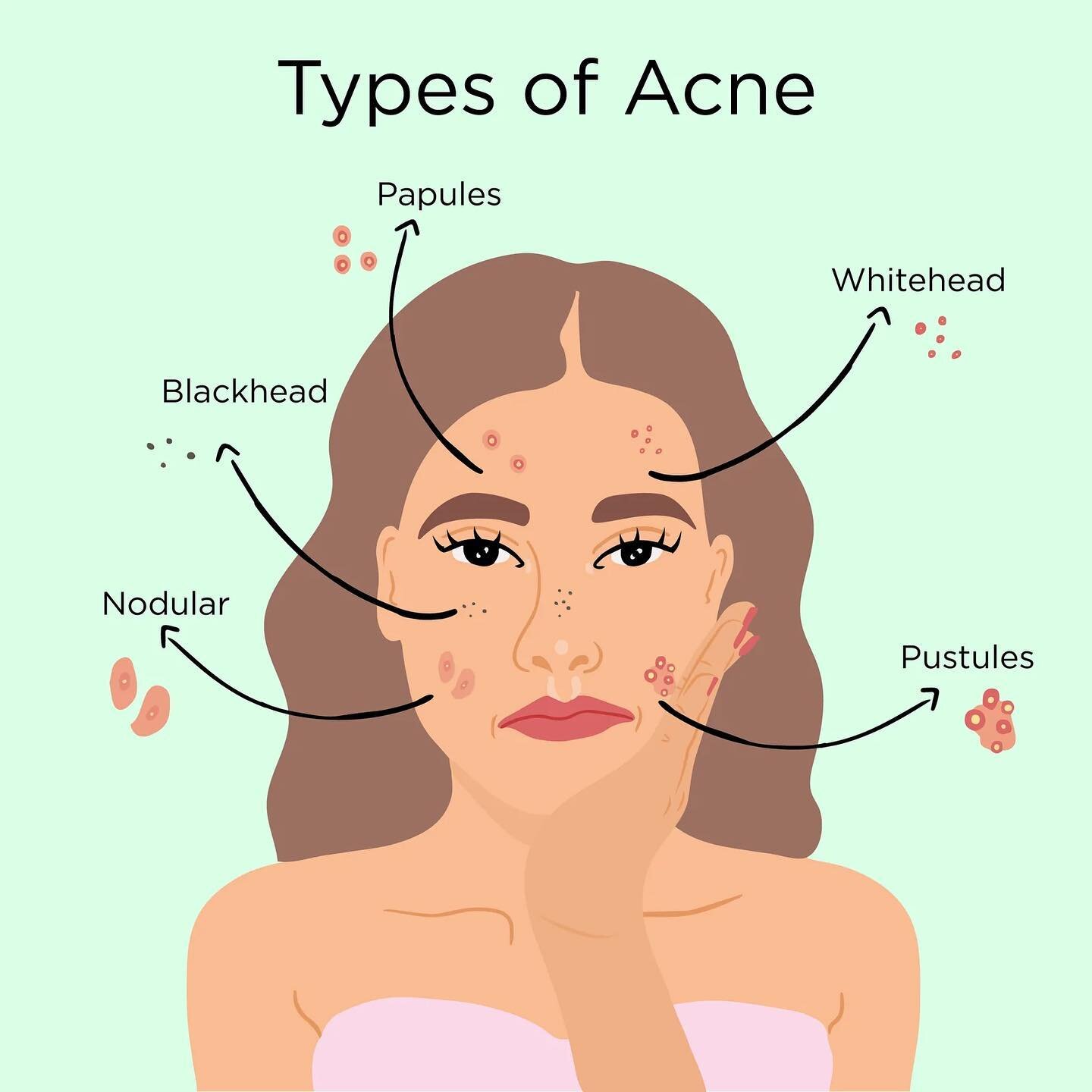 Acne is the skin condition most commonly seen by doctors. It occurs when pores become clogged by dead skin cells resulting in accumulation of sebum, an oily substance produced by oil glands.
Bacteria within pores, called Cutibacterium acnes (C. acnes