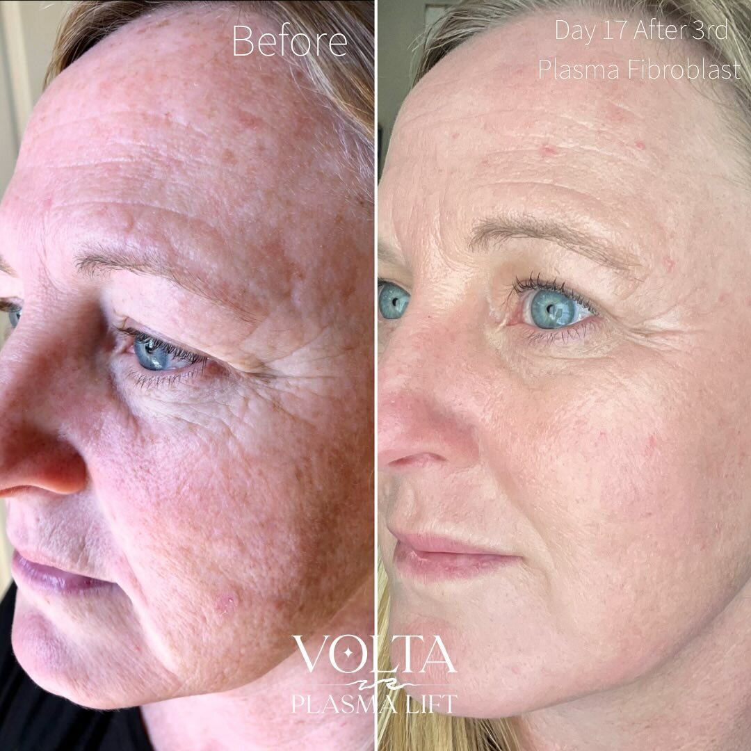 It is so satisfying to reverse sun damage and signs of aging in the skin without surgery or injectables! My amazing friend has been with me since the beginning of my plasma journey. We&rsquo;ve done 3 full face #plasmafibroblast treatments in 3 years