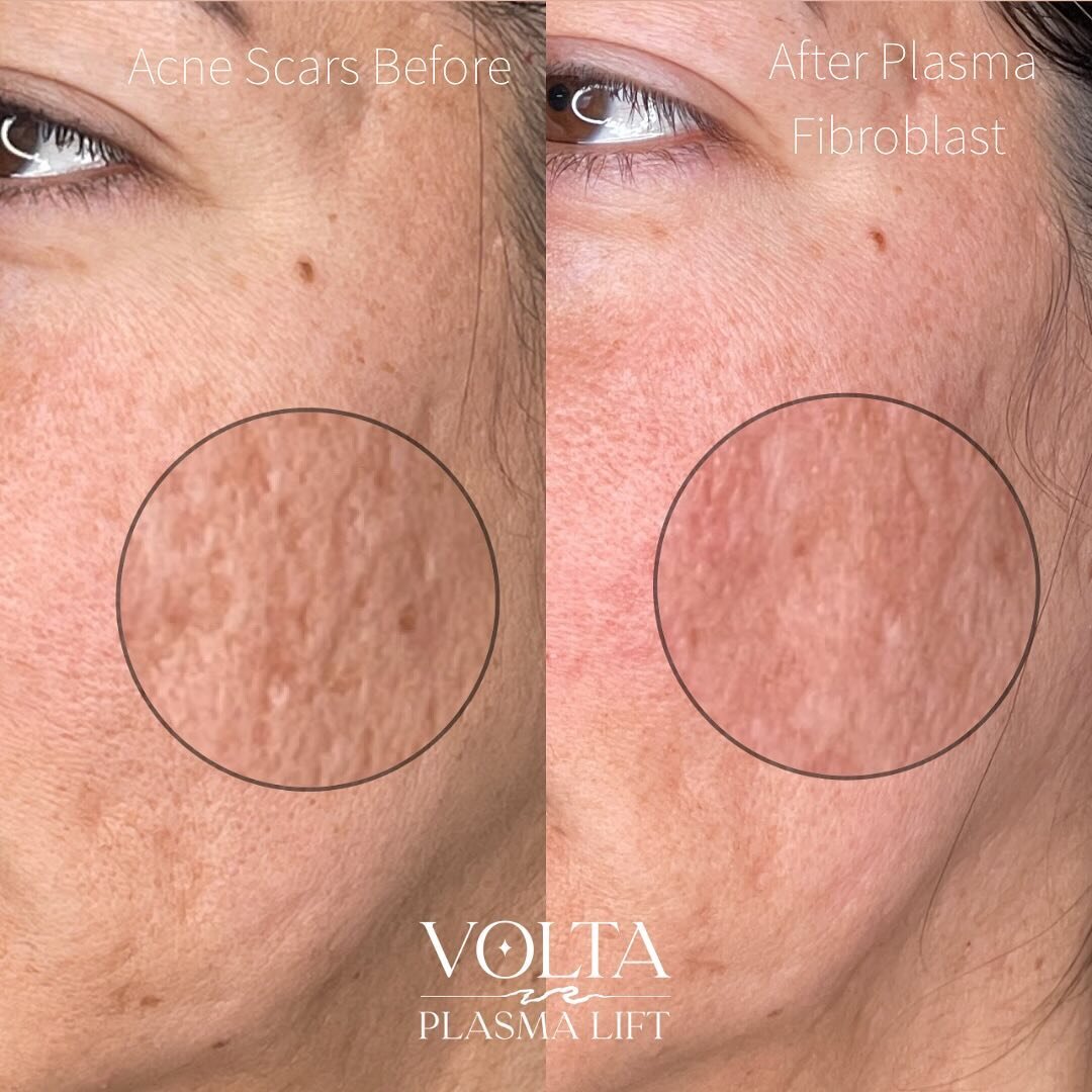My client&rsquo;s acne scars are greatly reduced after 1 #PlasmaFibroblast treatment!! We can reduce the depth and severity of acne scars 30-80% with a single fibroblast treatment! Additional treatments will only continue to improve and perfect the s