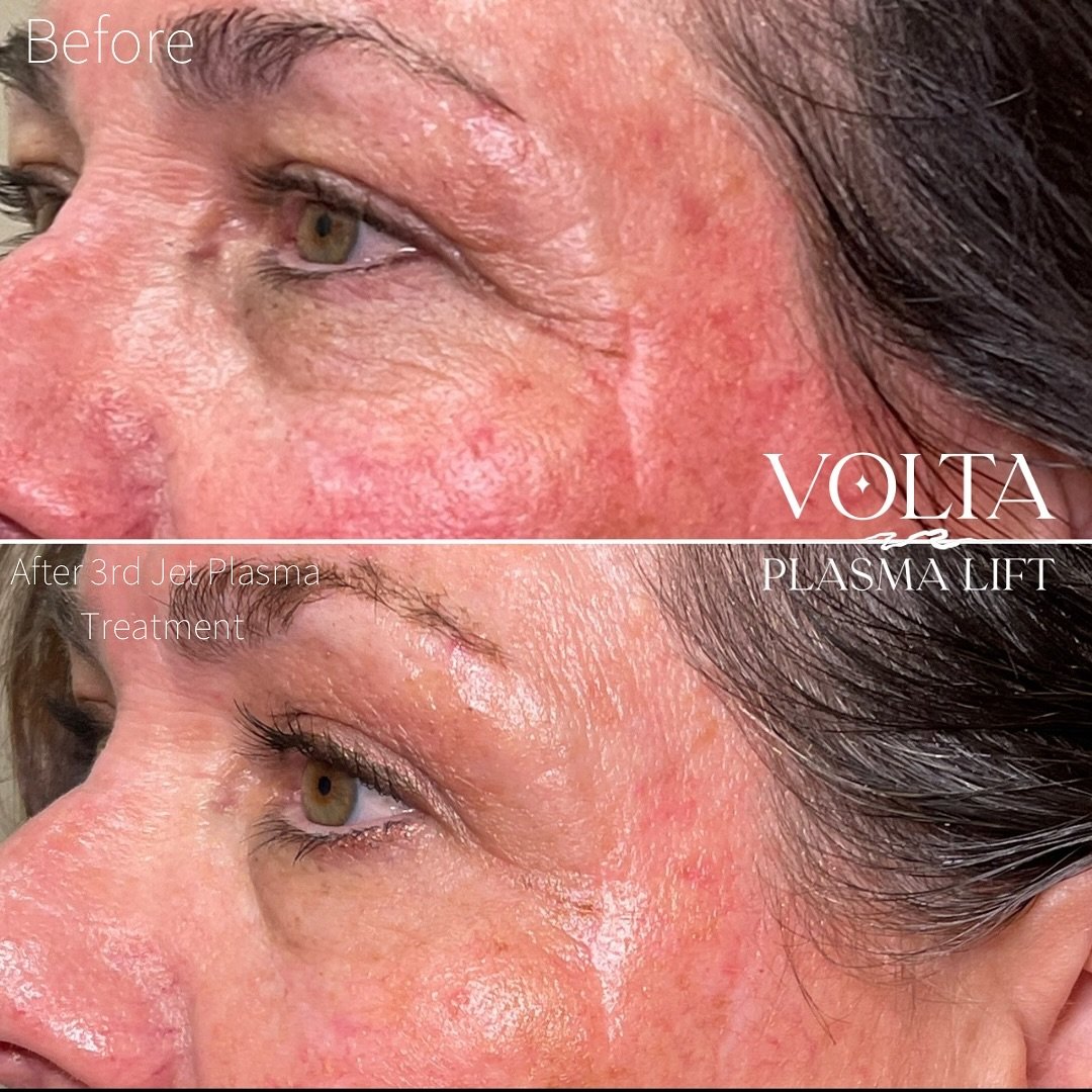 3 #JetPlasma treatments in and we&rsquo;re seeing redness reduction, scar reduction and lines diminishing on my amazing client! I hope everyone is having a lovely Spring - I am working Mondays &amp; Wednesdays @theloftsantacruz and doing home visits 