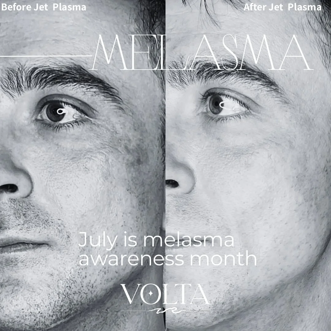 July is Melasma Awareness Month &mdash; and it&rsquo;s time to shed light on this deep and often frustrating skin condition.

Melasma isn&rsquo;t just &ldquo;sun damage.&rdquo; It&rsquo;s hormonal, heat-sensitive, and stubborn &mdash; and many popula