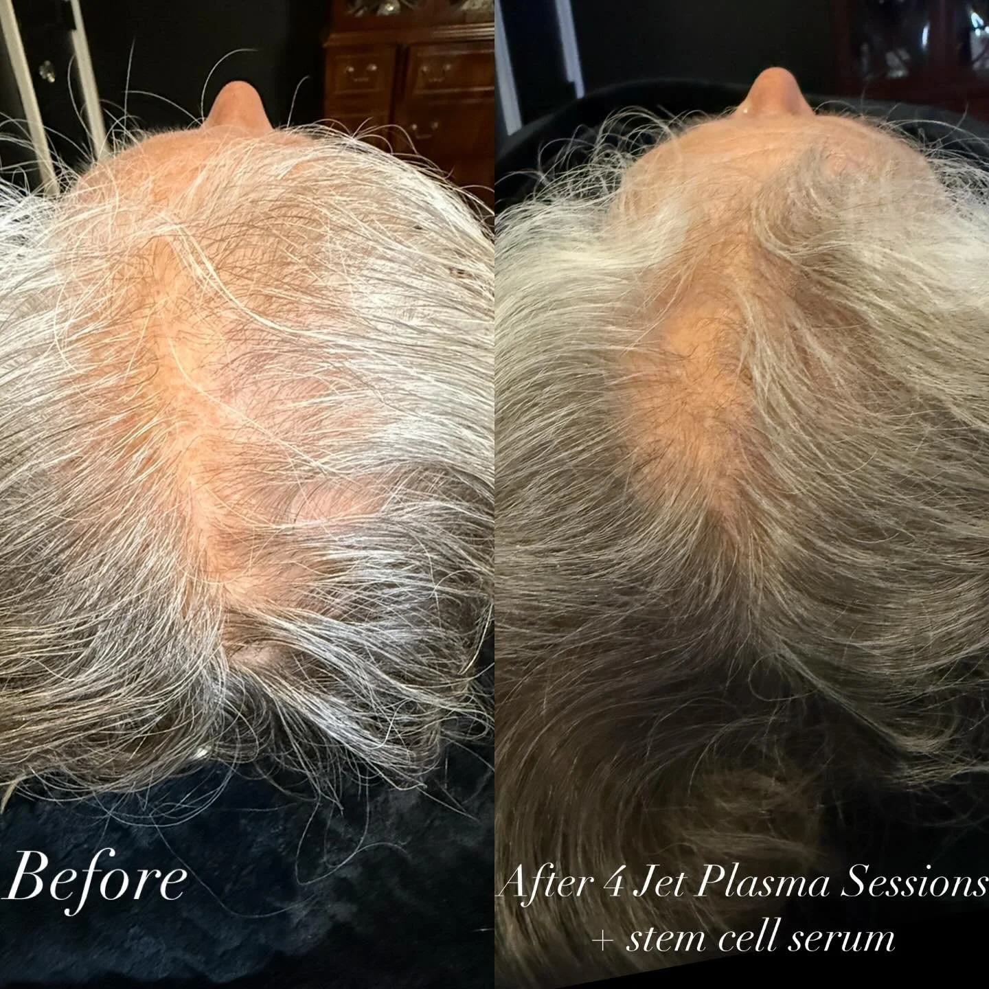 We are seeing hair regrowth after 4 Jet Plasma Scalp Rejuvenation Treatments over 7 weeks! I apply a stem cell serum after each treatment as well! Can&rsquo;t wait to keep up the progress! ⚡️💜⚡️Jet Plasma increases circulation, awakens dormant folli