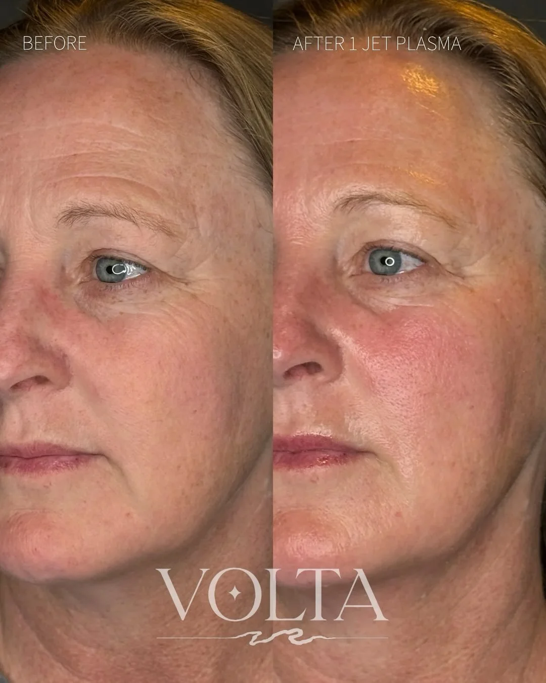 Many signs of facial aging stem from lack of hydration. Jet Plasma helps your skin remember how to hydrate itself. 💧✨
This advanced treatment delivers cold atmospheric plasma deep into the skin, stimulating keratinocytes and fibroblasts (your skin&r