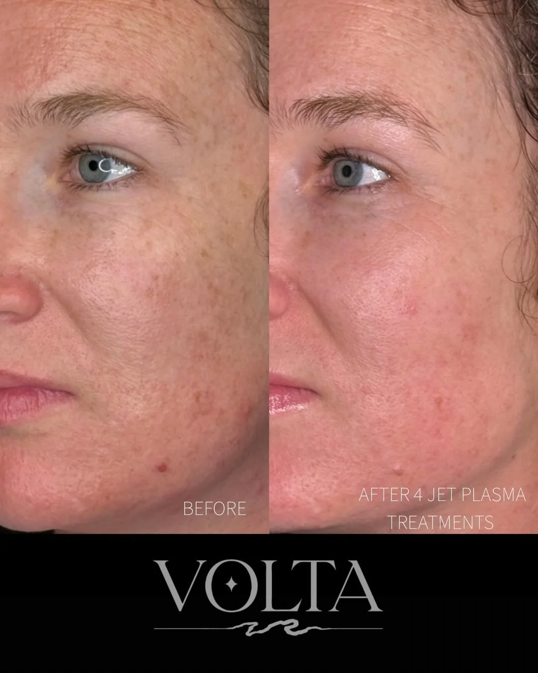 ✨ Jet Plasma results you can see ✨

Look at this lovely progress! This client came to us wanting to even out pigmentation and smooth her skin&rsquo;s texture &mdash; and after just a few Jet Plasma sessions, her skin is visibly brighter, clearer, and