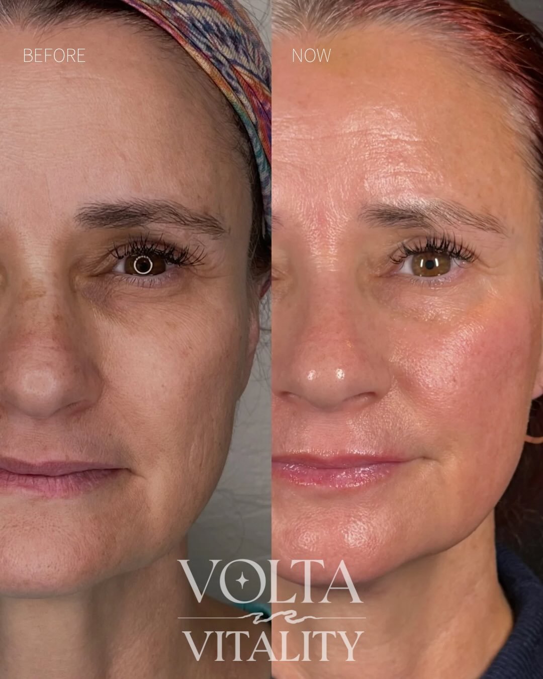 This is what skin investment over time looks like 🔥

1 Panda Eye Treatment 
2 Full Face Plasma Fibroblast Treatments
3 Series of Jet Plasma

Three years between these photos! Our client&rsquo;s skin is smoother, firmer, brighter, and so radiant! 🥰
