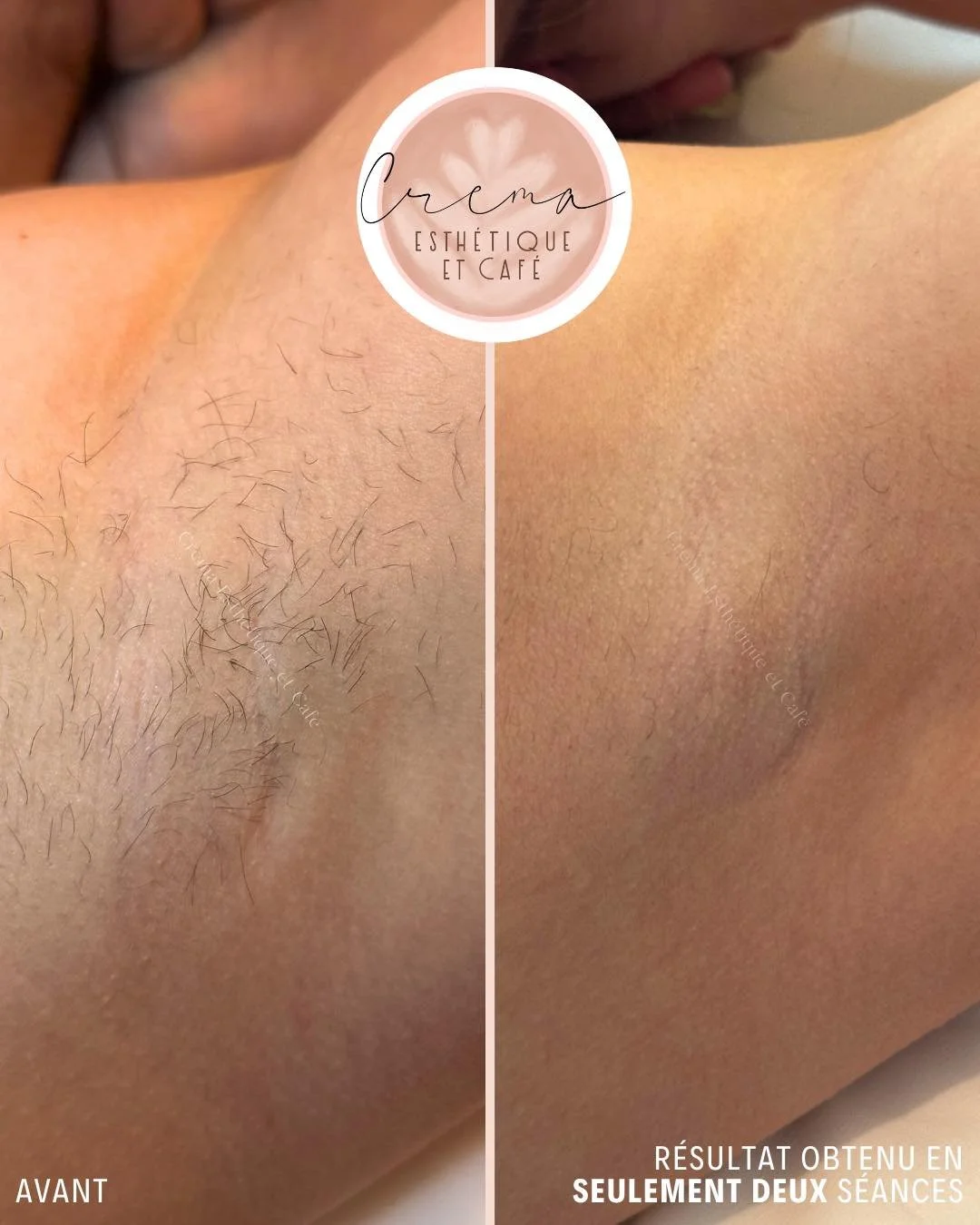 𝐄́𝐯𝐨𝐥𝐮𝐭𝐢𝐨𝐧 𝐚𝐩𝐫𝐞̀𝐬 𝐬𝐞𝐮𝐥𝐞𝐦𝐞𝐧𝐭 2 𝐬𝐞́𝐚𝐧𝐜𝐞𝐬 de laser, espac&eacute;es de six semaines chacune. ✨

Poils clairsem&eacute;s et plus fins. Peau lisse, douce et quasi sans poils. 🤩

Le laser agit 𝒑𝒓𝒐𝒈𝒓𝒆𝒔𝒔𝒊𝒗𝒆𝒎𝒆𝒏𝒕; 
