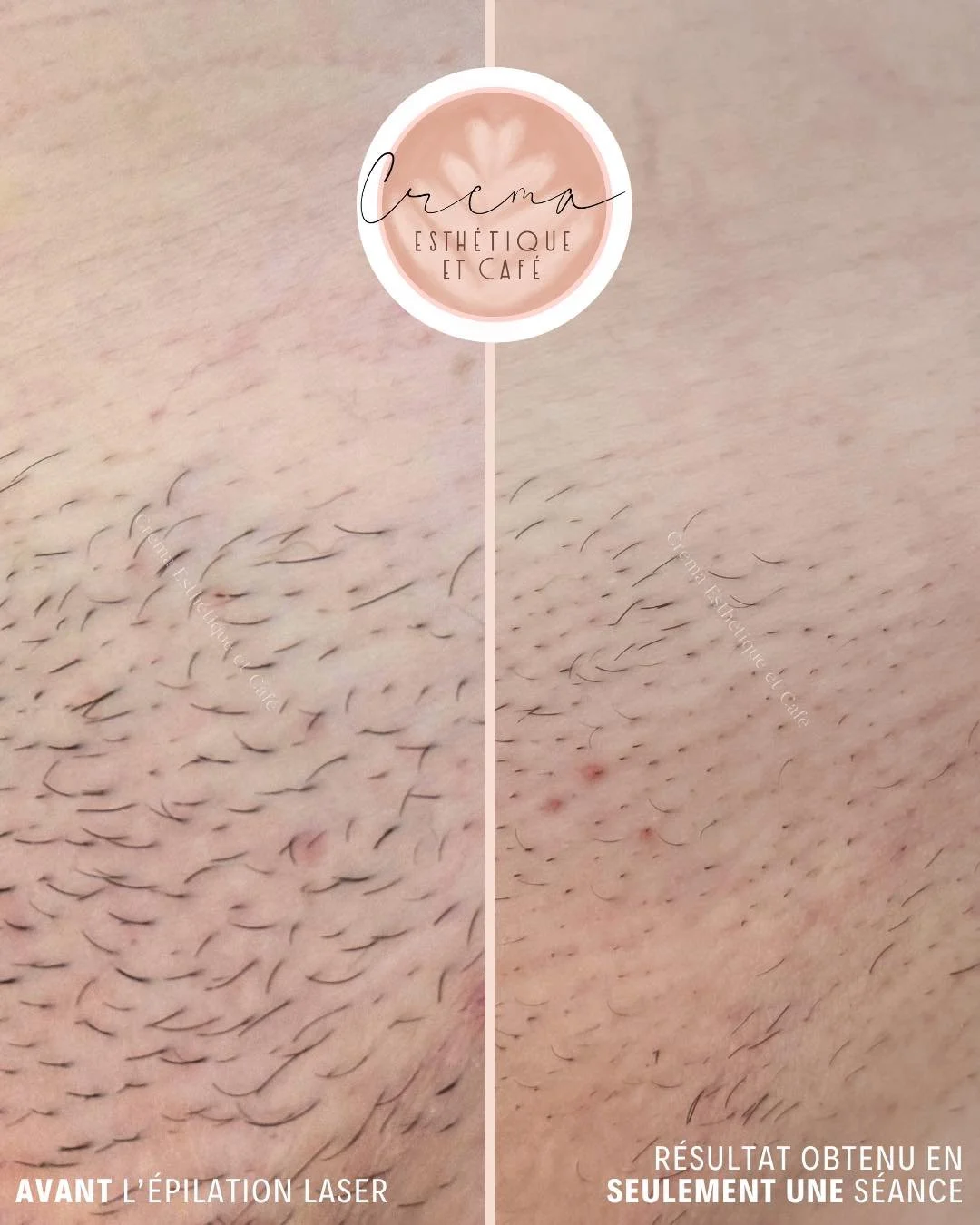 R&eacute;sultat obtenu en 𝐬𝐞𝐮𝐥𝐞𝐦𝐞𝐧𝐭 𝐮𝐧𝐞 𝐬𝐞́𝐚𝐧𝐜𝐞 ! 🤩

𝐏𝐫𝐨𝐜𝐡𝐚𝐢𝐧𝐞 𝐬𝐞́𝐚𝐧𝐜𝐞 𝐥𝐚𝐬𝐞𝐫 : 𝐝𝐢𝐦𝐚𝐧𝐜𝐡𝐞, 𝟏𝟐 𝐚𝐯𝐫𝐢𝐥. Deux disponibilit&eacute;s seulement 👉 assure ta place avant qu&rsquo;il ne soit trop tard !

Le