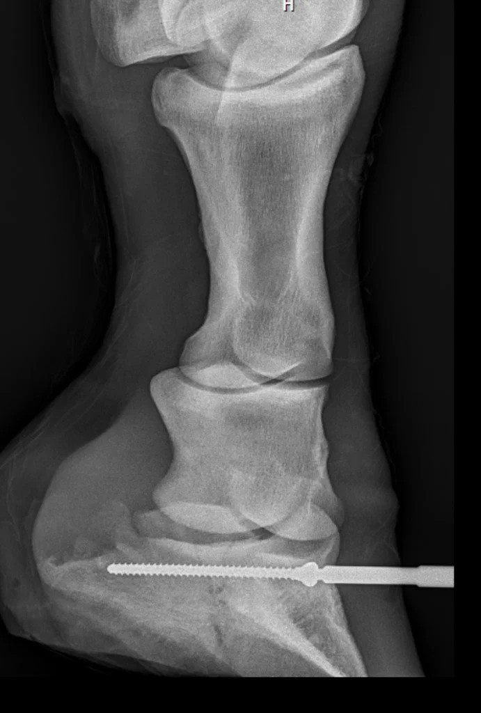 DARWIN P3 fx with screw in intraop.jpg
