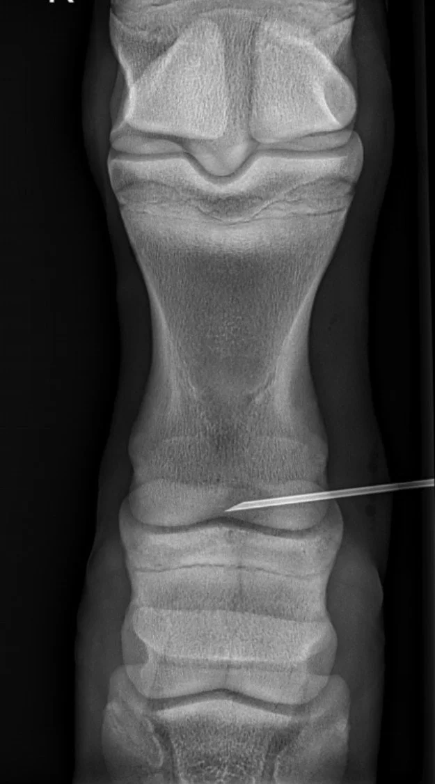BOUDOUR BABE RH pastern osteo drilled hole.jpg