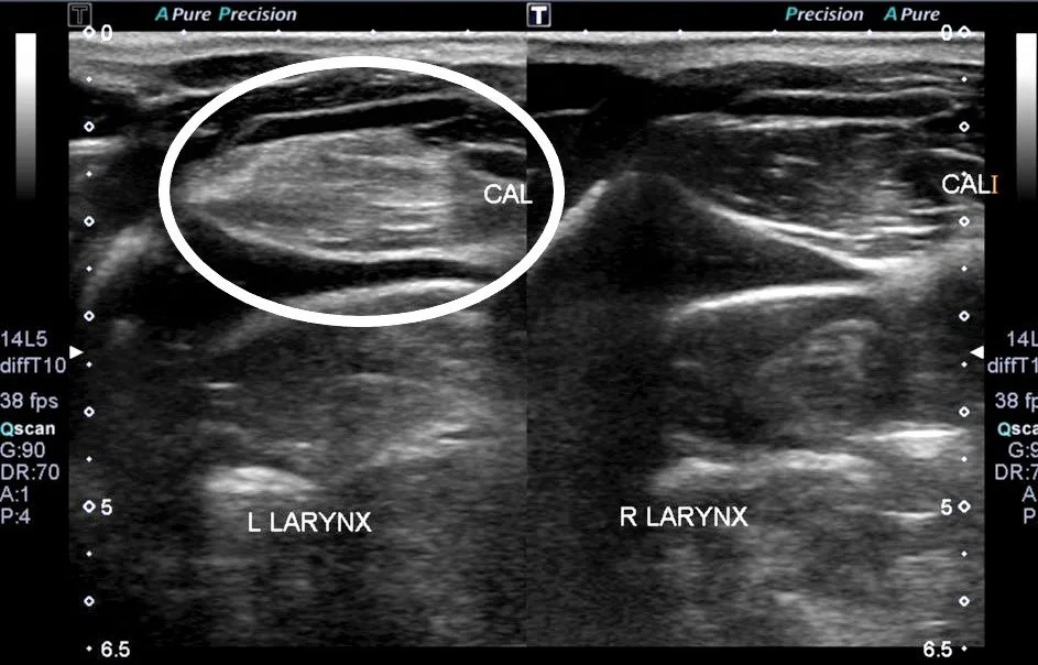 SCARLETT STRIPE marked CAL atrophy USE demo.jpg