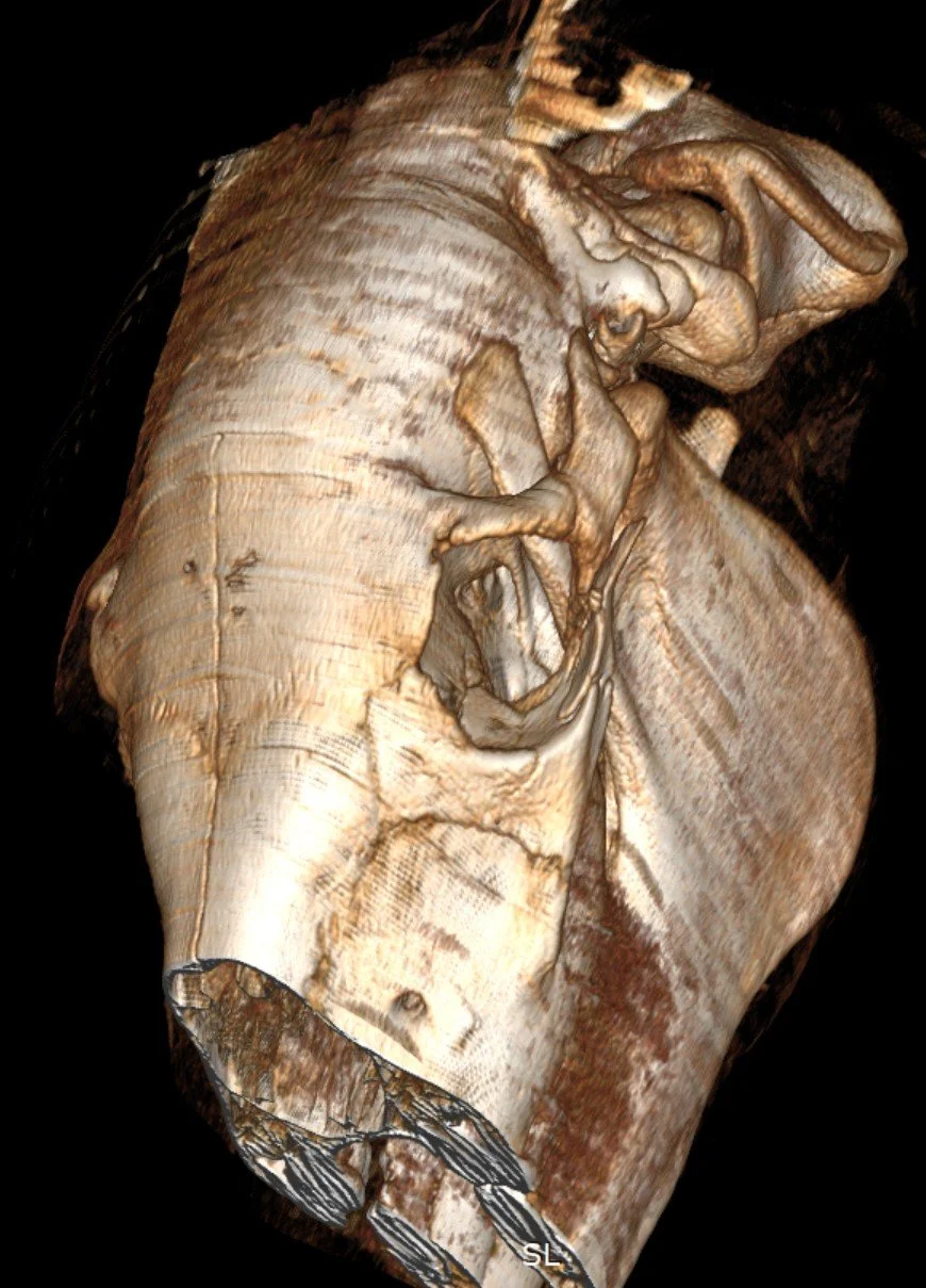 ALWAY'S GIGGLING '25 head CT orbital fx .jpg