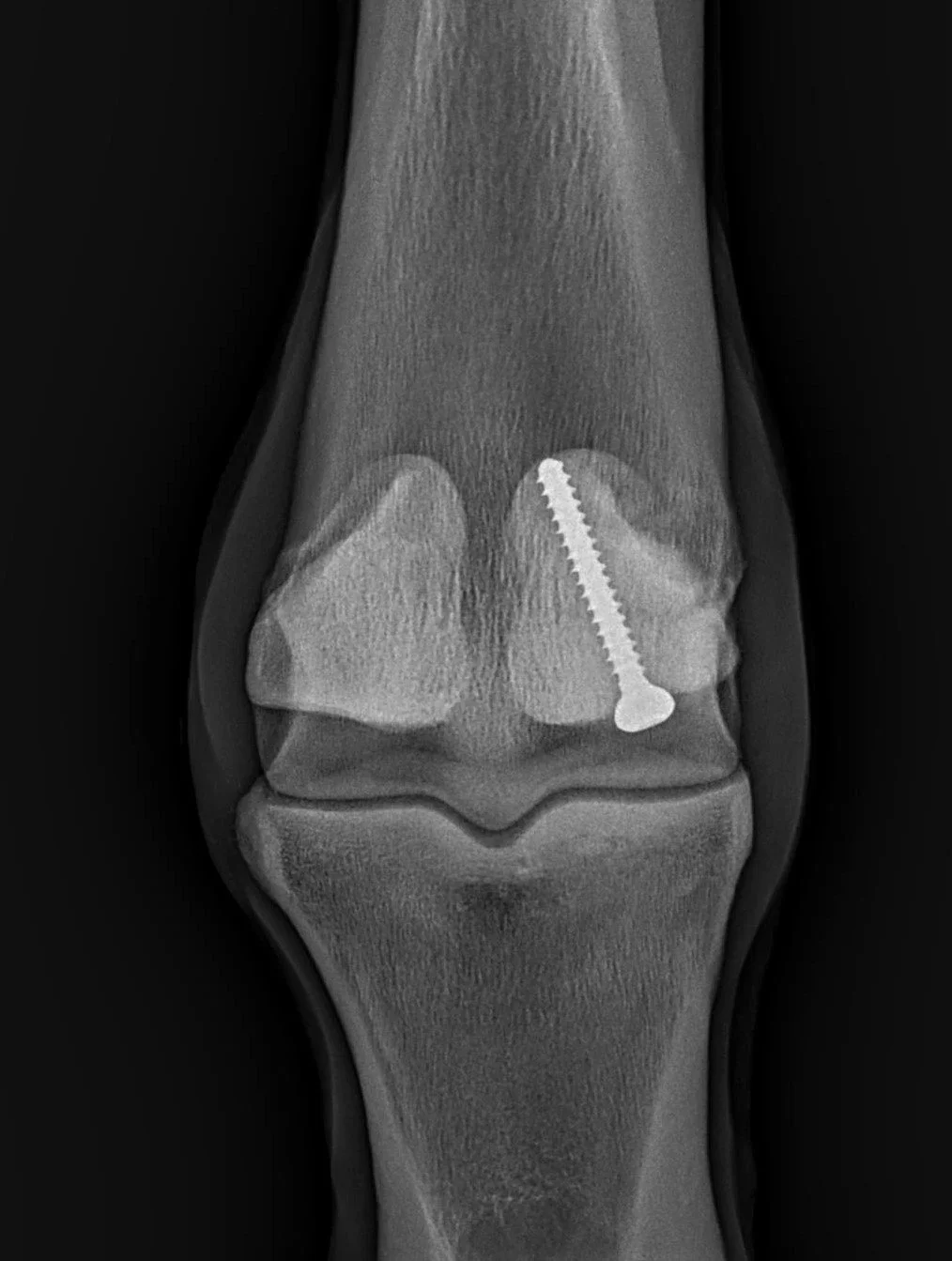 MASHNEE GIRL 5 mos postop.jpg