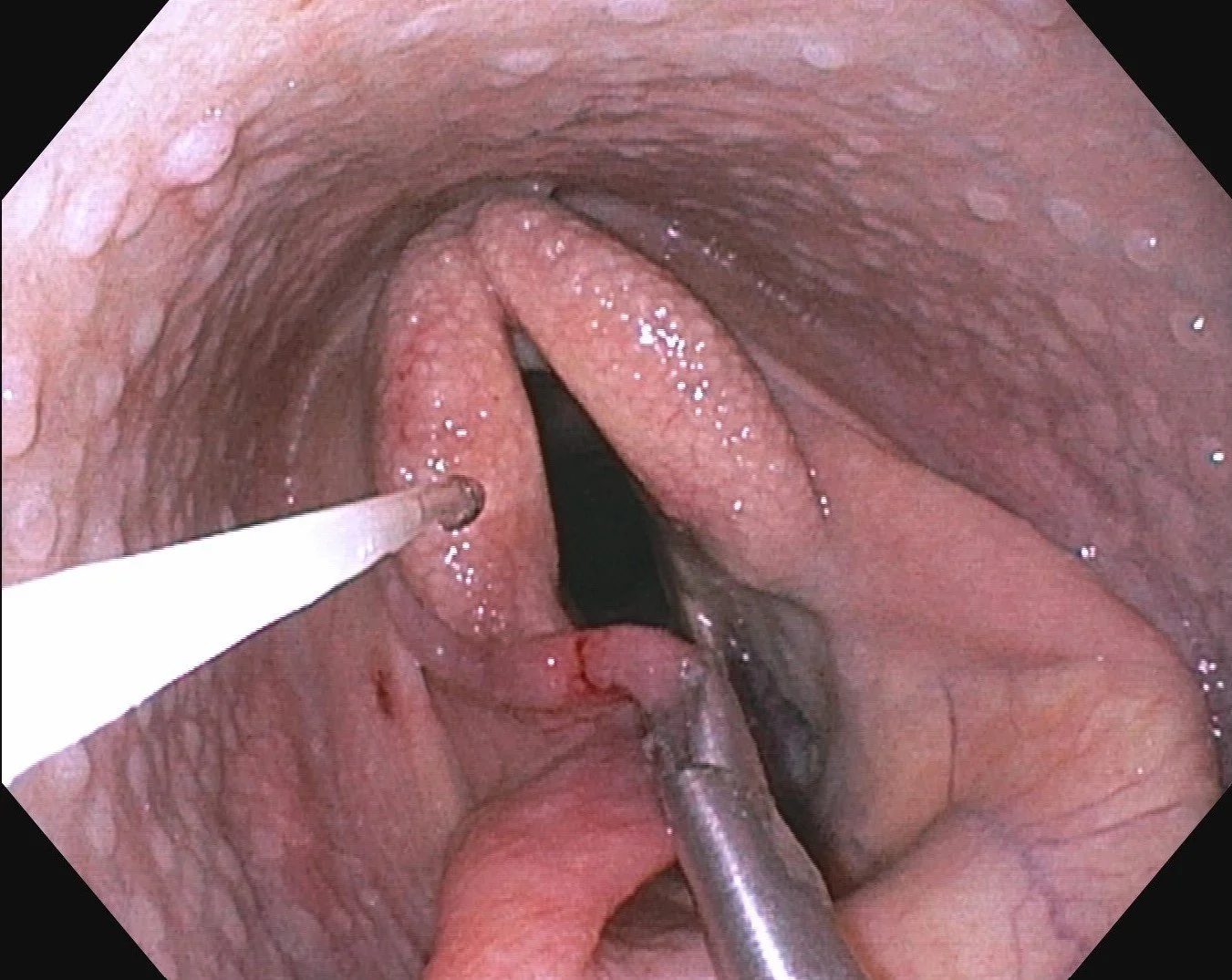 DRAGON REBORN AEF resection .jpg