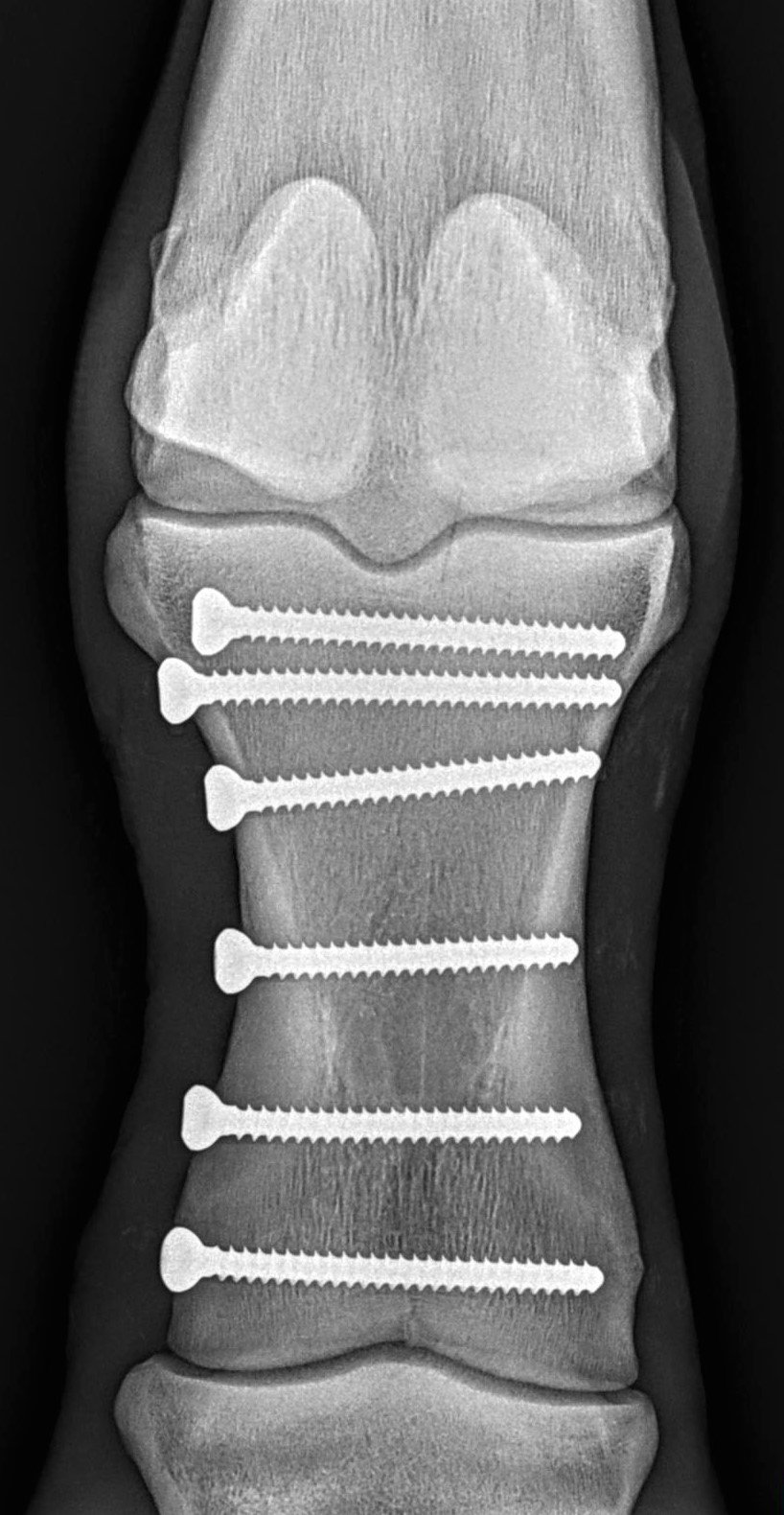 D'VINICRIS complete displaced postop.jpg