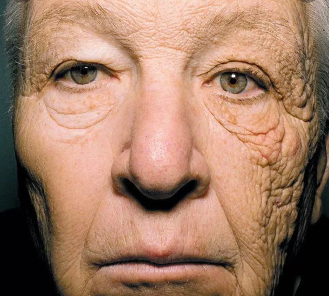 &ldquo;Do I really need all those products?&rdquo;
There is a reason for all the products a skin care professional recommends, each of them have their own purpose. 

This gentleman was a truck driver for 28 years, he never wore sun protection. Look a