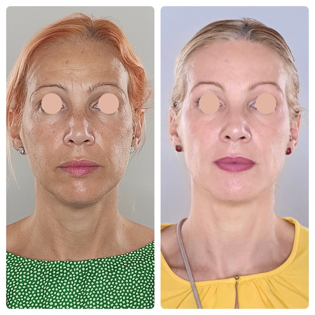 Cuidado facial mujer antimanchas