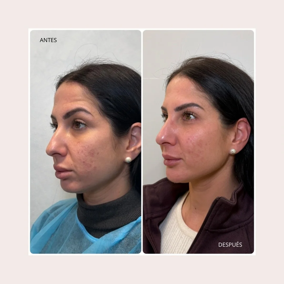 ❤️ Antes y despu&eacute;s de armonizaci&oacute;n facial ❤️. &iquest;Te gustar&iacute;a saber qu&eacute; hemos realizado? 

Cu&eacute;ntame qu&eacute; te parece! 👇🏻🙏

#armonizacionfacial #medicinaesteticavalencia