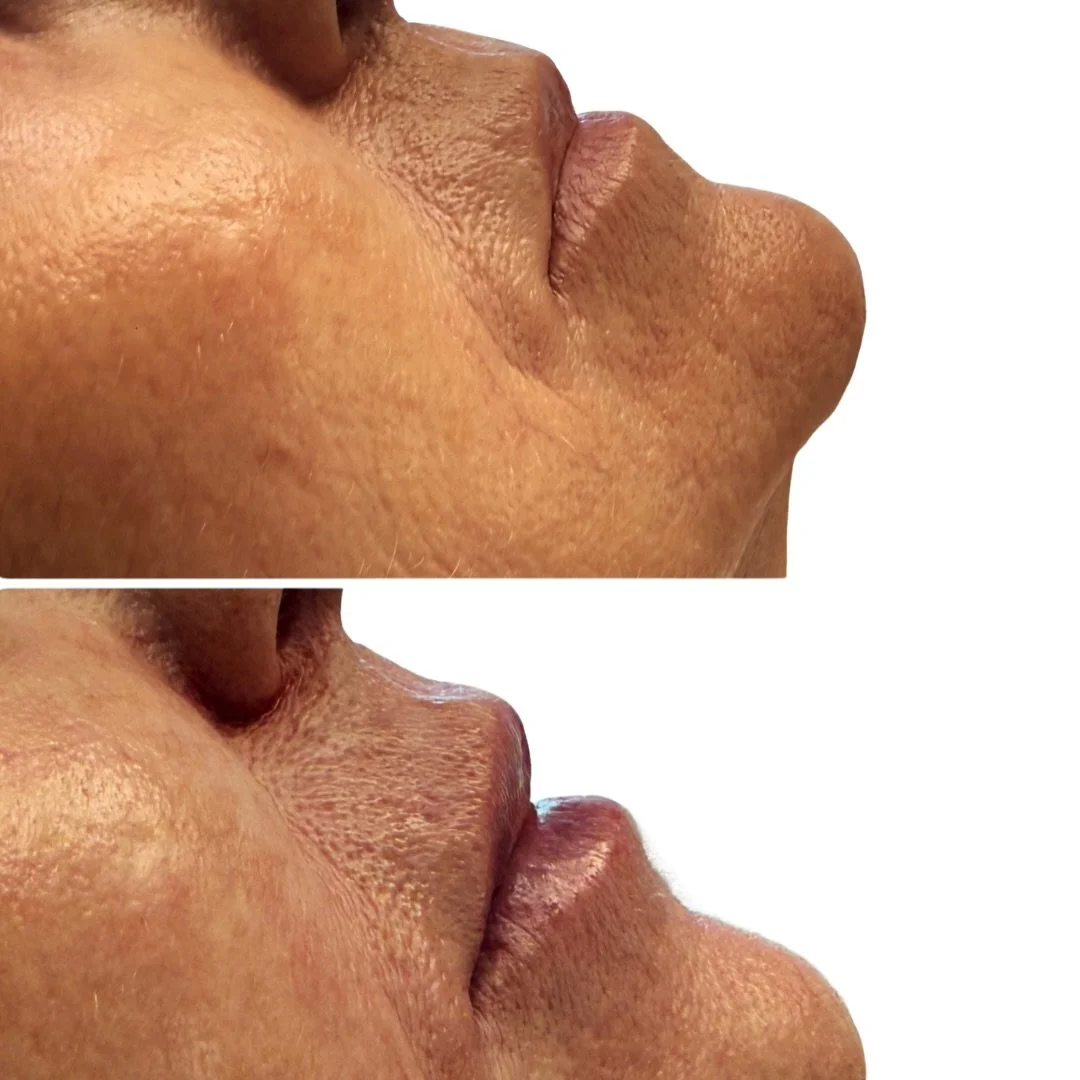 Antes y despu&eacute;s de labio 👇🏻👄 &iquest;qu&eacute; cambios ves? 

En el antes vemos un labio envejecido con p&eacute;rdida de definici&oacute;n y del perfil. Sin arco de cupido y una distancia mayor desde la base de la nariz al labio. 

En el 