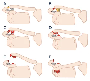 Acromioclavicular Joint Injuries — Dr Jeevaka (Jay) Amaranath ...