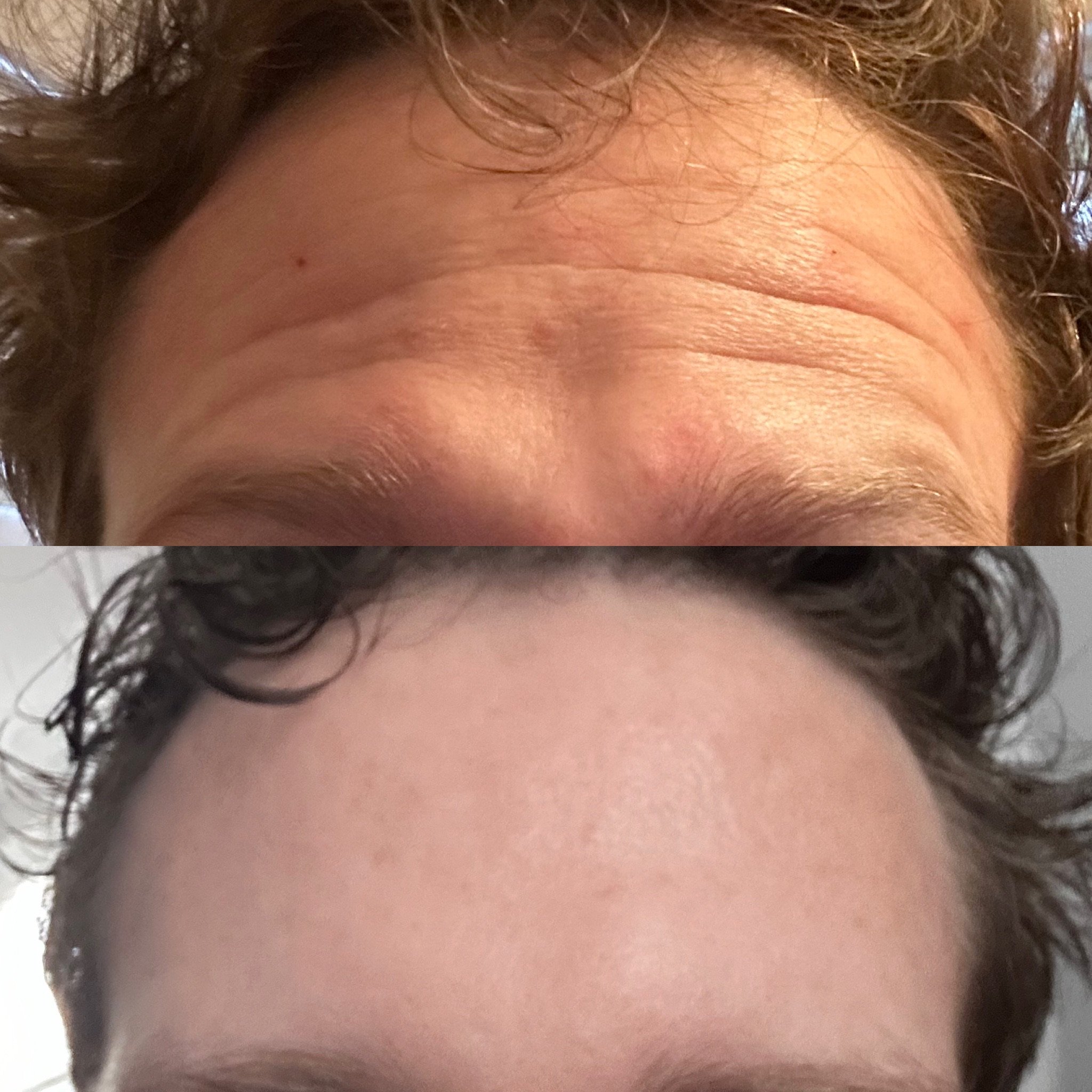 Male Botox - Forehead and 11's