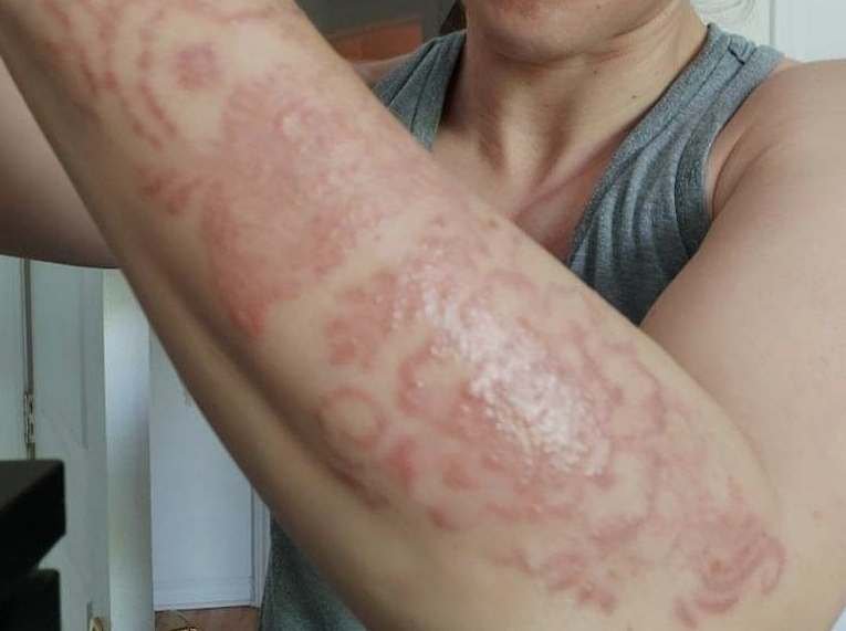 Que faire en cas de réaction allergique au jagua?