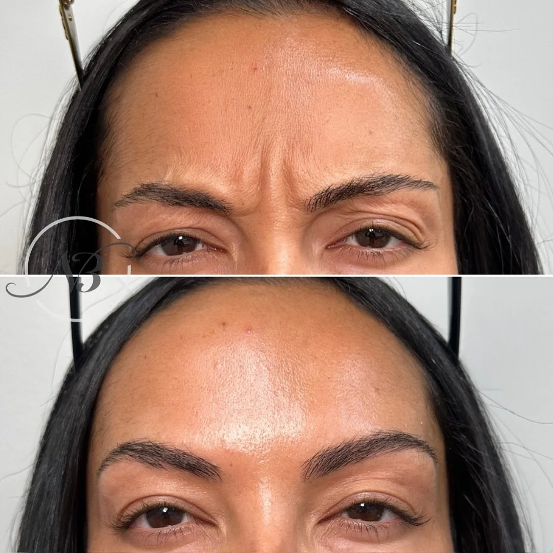 Tox Before and Afters with Nurse Katie!
Her results are 😍😍
✨️To book online with us click the link in our bio, send us a DM @nubellamedspa or give us a call at 949.614.0052
📍Irvine (Located in Barranca Medical Plaza)
📍Rancho Cucamonga (Locat