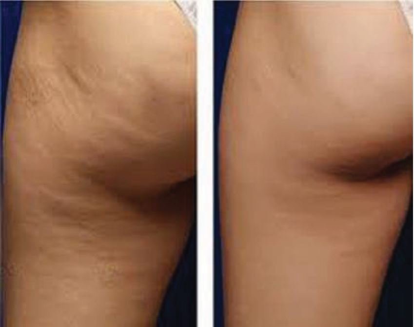 Thighs after five Cryo T-Shock cellulite treatments
