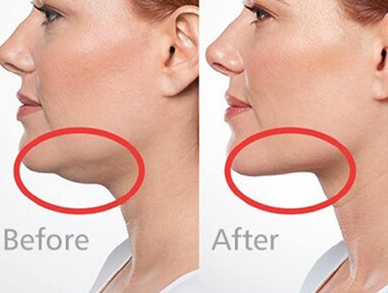 Get rid of double chin