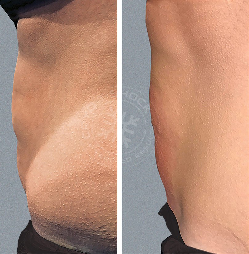 Abdomen after nine Cry T-Chock slimming treatments