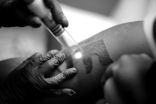 Laser Tattoo Removal in Denver, CO — Certified Tattoo Studios