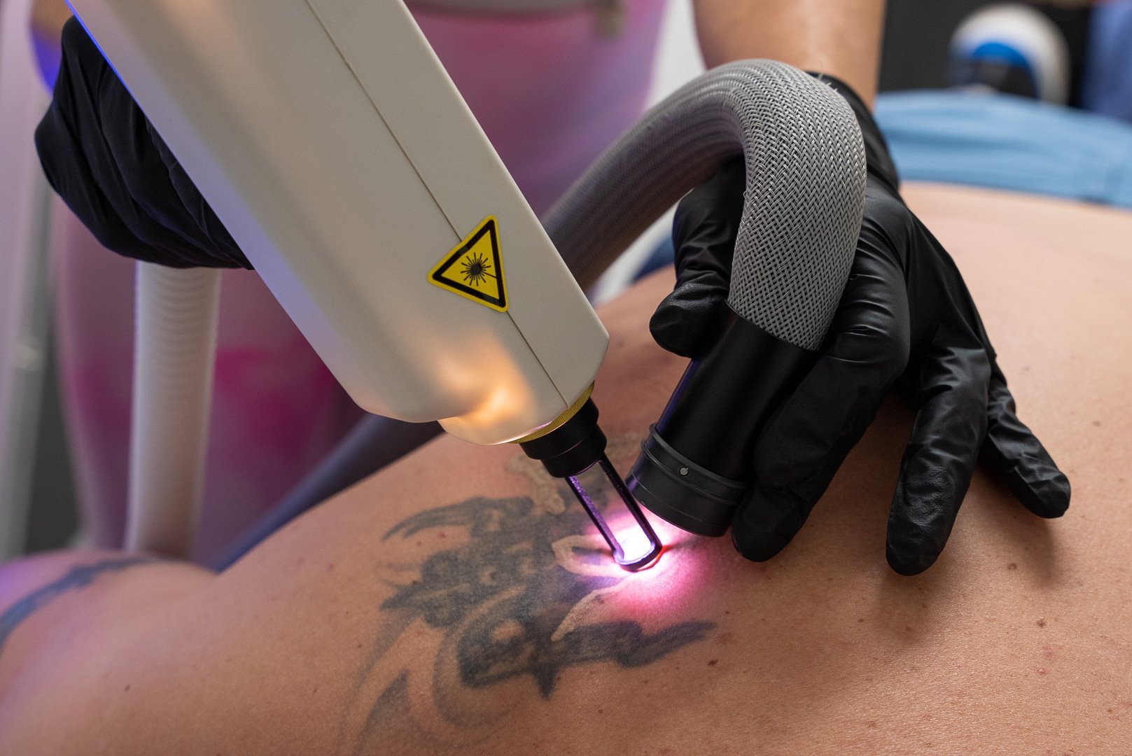 The smart way to remove the unwanted tattoo