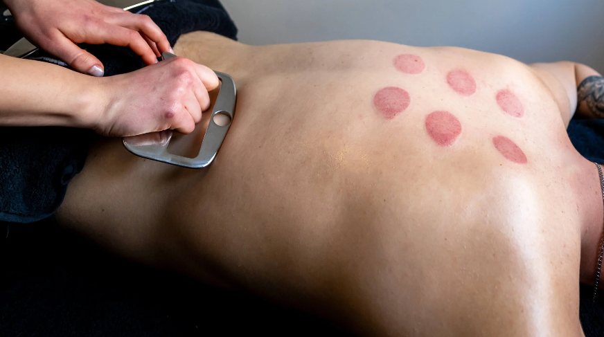 Person receiving cupping therapy on their back, with several round red marks visible.