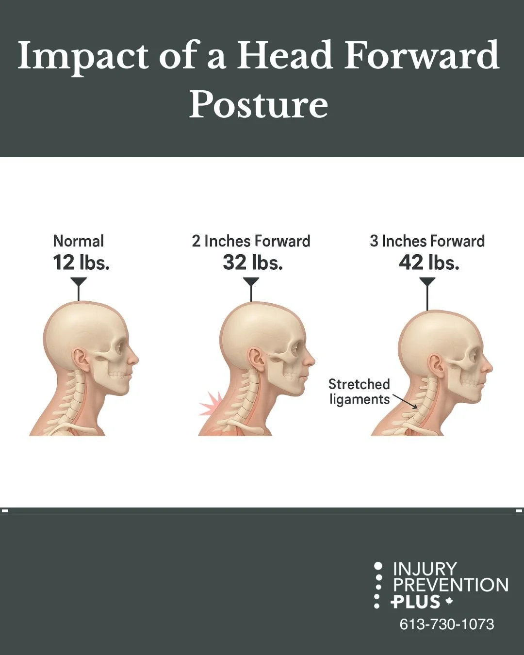 This updated visual illustrates a critical concept in ergonomics: how subtle changes in head position can significantly increase the mechanical load on the cervical spine.

-Neutral Head Position: ~12 lbs of force
-2 Inches Forward: ~32 lbs
-3 Inches