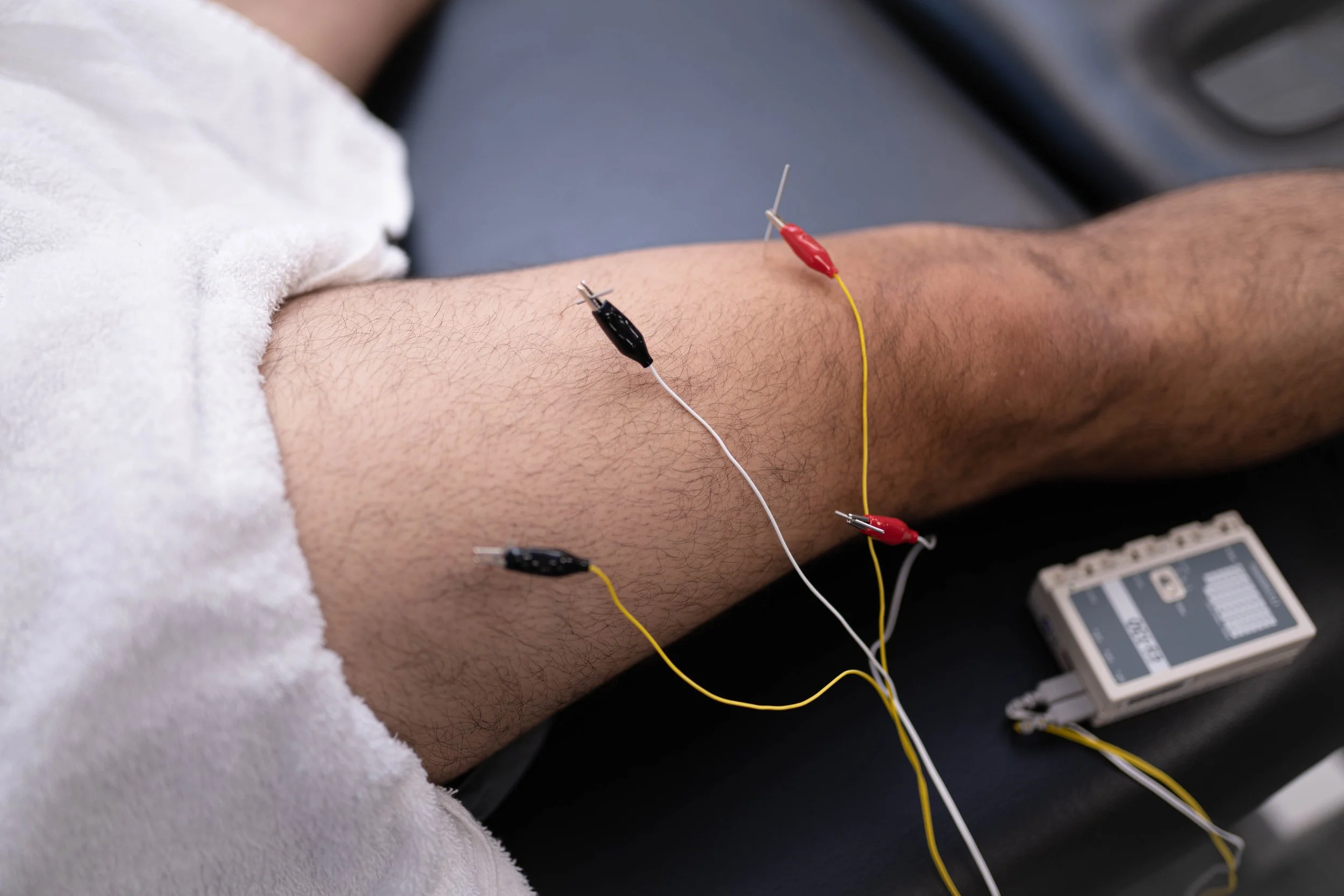 Dry Needling in San Antonio